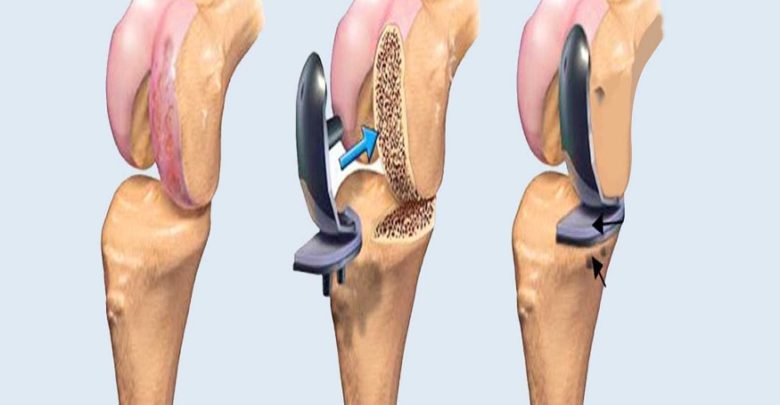 How to Prepare for Joint Replacement Surgery