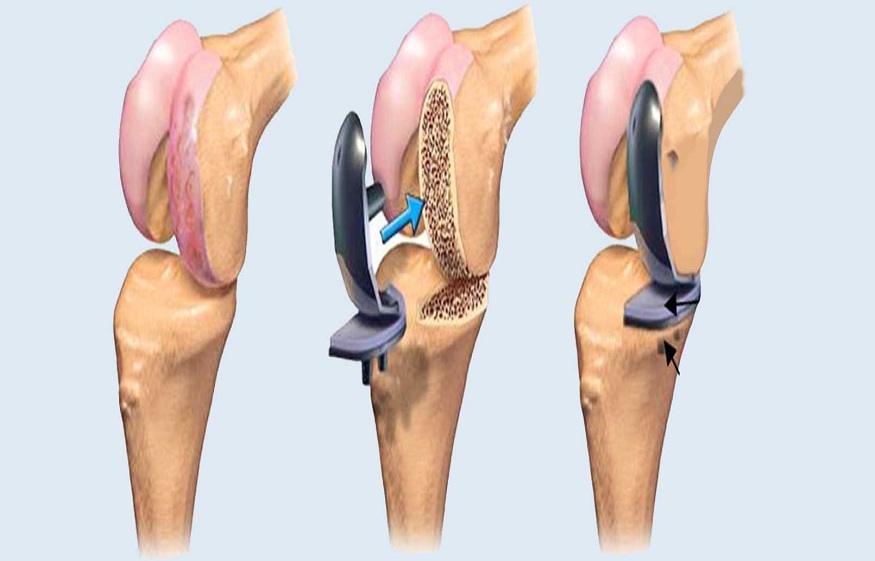 How To Prepare For Joint Replacement Surgery